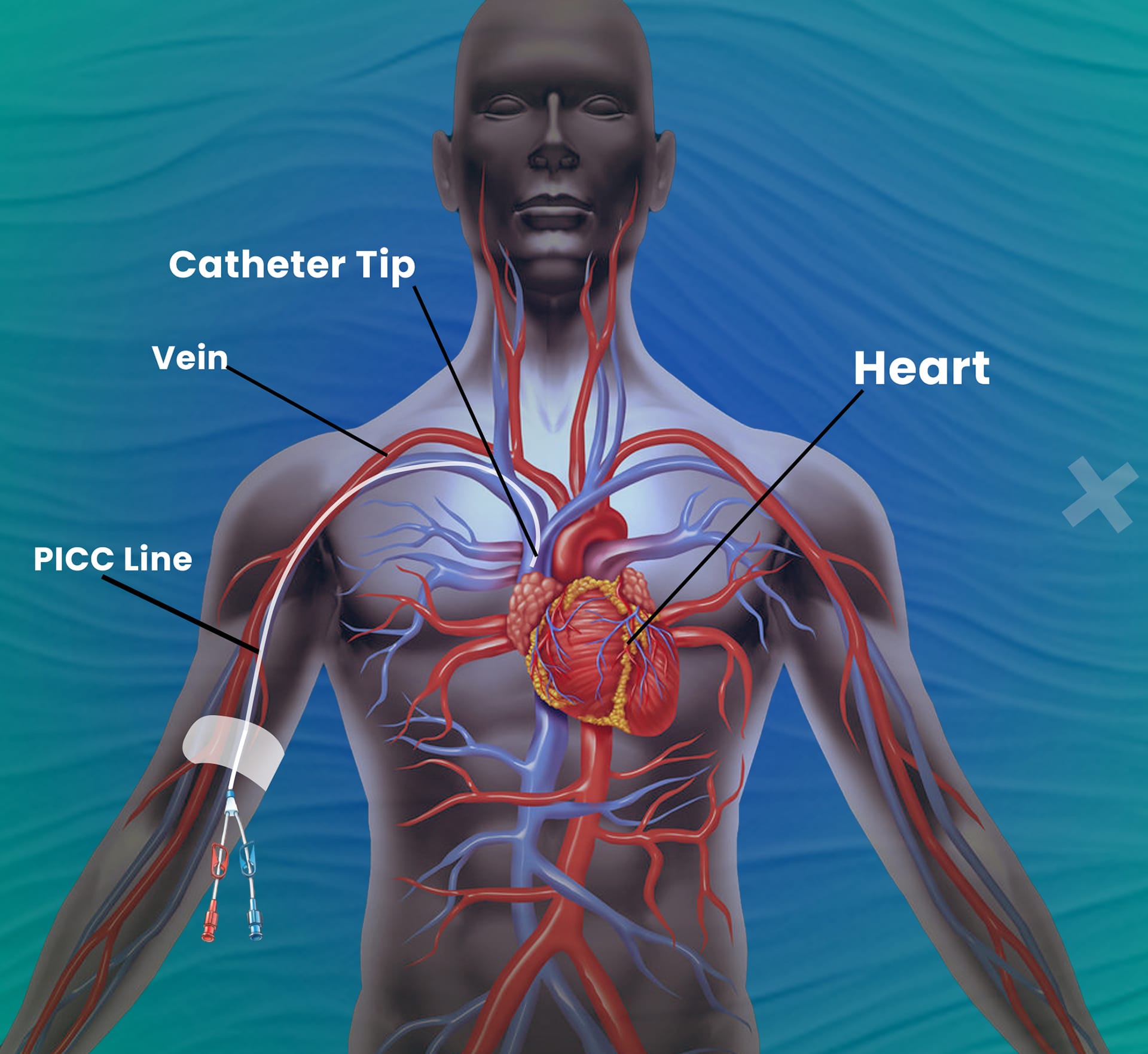 PICC Line Peripherally Inserted Central Catheter North East 