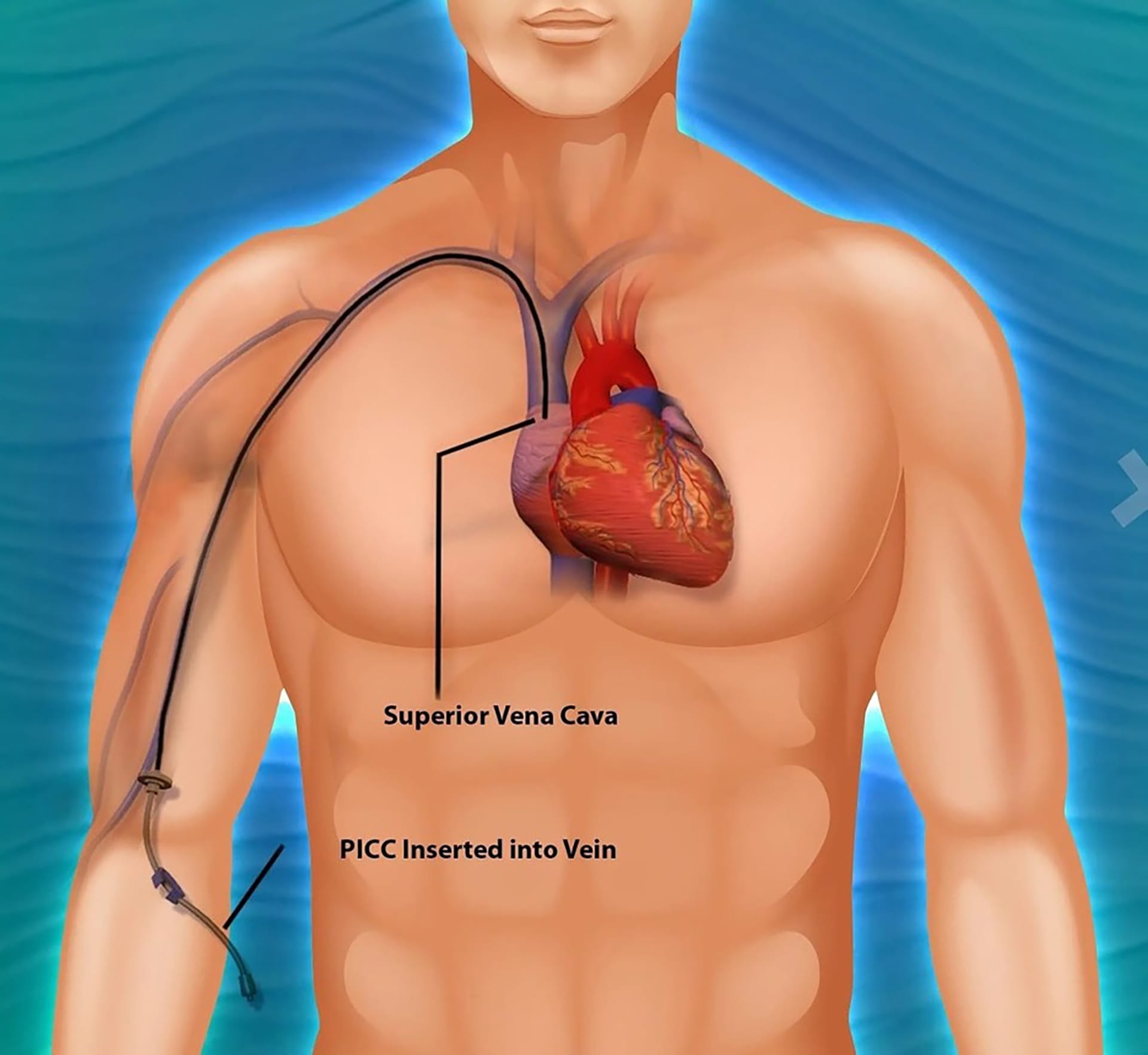 PICC-Line-Peripherally-Inserted-Central-Catheter